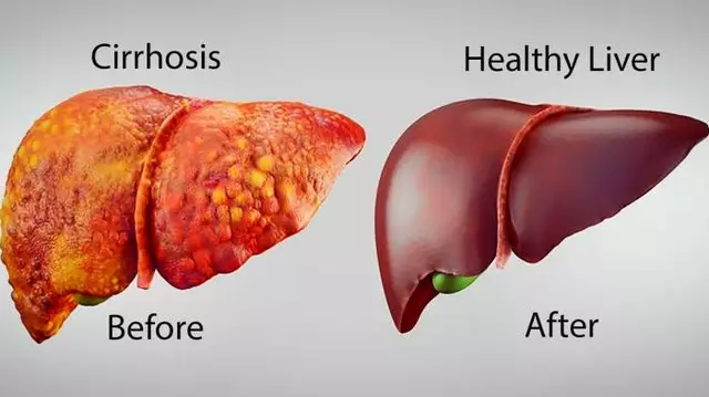 Primaquine and liver health: What you need to know